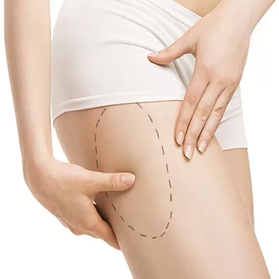 Braquipoplastia